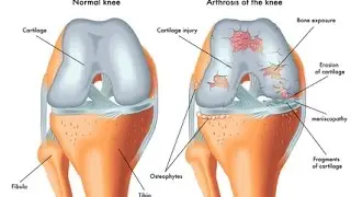 2016 Arthritis Stem Cell Therapy In New York