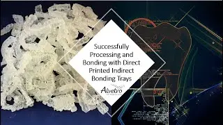 How to post process 3D printed 3Shape Indirect Bonding trays.  Video includes clinical bonding step.