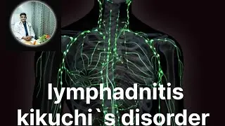 Swelling in lymp nodes (lymphadenitis kikuchi's) disease/disorder 