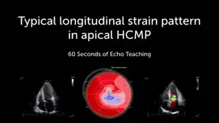 Typical Longitudinal strain in Apical HCMP
