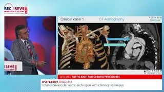 BEC 2021 | Total endovascular aortic arch repair with chimney technique | Ivo Petrov