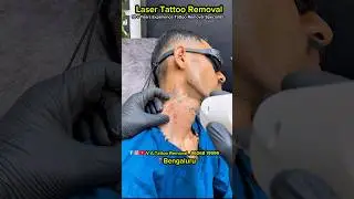 Neck Permanent Tattoo Removal Laser Treatment Bengaluru | V A Tattoo Removal | #tattooremoval #laser