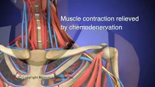 Thoracic Outlet Syndrome (TOS) Animation HD