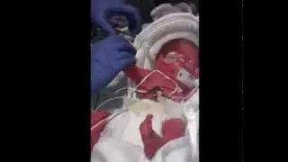 Little Leon Leaps of Love: A Micro Preemies First Few Moments.