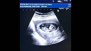 1st Trimester NT scan