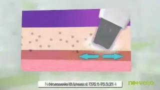 video tratament fermitate Converted