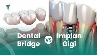 Dental Bridge vs Implan Gigi, Lebih Bagus yang Mana?