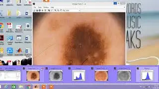 Skin Cancer Prediction using Machine Learning