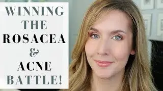 HOW I GOT RID OF ROSACEA AND ADULT ACNE | Products + Tips + Lifestyle Changes | My Story