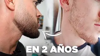 MI EVOLUCIÓN tras 2 AÑOS de MINOXIDIL