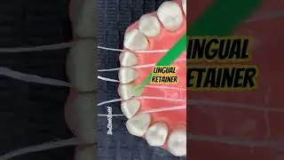 Lingual Retainer