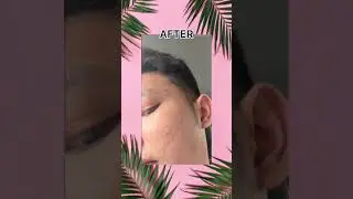 Everyone can wear NIHON 🥰 #nomoreacne #acnegoaway #flawlesskin
