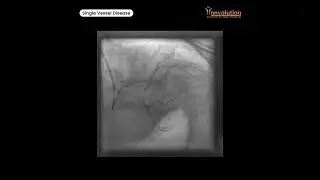 Single Vessel Disease