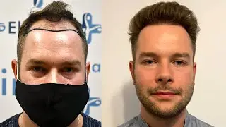 Trapianto di capelli prima e dopo in avanzamento rapido #5