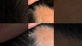 Resultados despu&eacute;s de tres meses usando minoxidil (1/2)