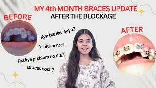  “4 Month Braces Update 😭💔 | pain, progress, smile full explanation 🥺🦷