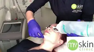 How to Fade Freckles and Sun Spots with Laser