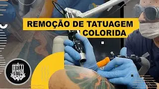 Remoção de Tatuagem COLORIDA!