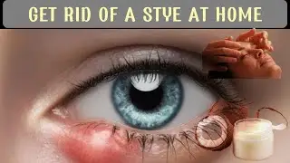 How To Get Rid Of A Stye At Home Natural Remedies For Stye Best Ways To Get Rid Of A Stye Easily