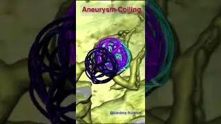 Brain Aneurysm Coiling