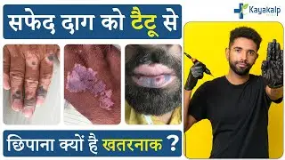 Tattoo for Vitiligo (सफेद दाग)| Vitiligo Tattoo| Vitiligo Tattoo Treatment in Delhi| Kayakalp Global
