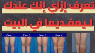 تعرف إزاي إنك عندك لــيمفـد يما في البـيت| lymphedema #علاج_طبيعي #اكسبلور #lymphedema #الليمفديما