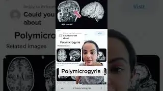 Polymicrogyria