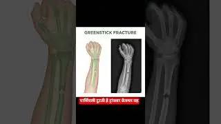 Types of Fracture Explained | X-Ray vs Real Bone | AIIMS & Paramedical