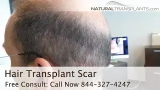 Hair Transplant Scars by Natural Transplants vs. Other Clinic Hair Transplant Scar