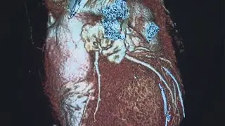 Right ventricle enlargement a major predictor for mortality among COVID patients, new study finds