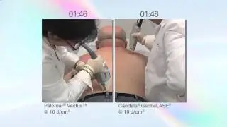 The Palomar Vectus Laser vs  the Syneron Candela GentleLase