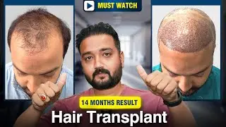 Hairfree & Hairgrow Ahmedabad Hair Transplant Result | Real Patient Review After 15 Months