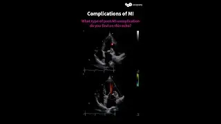 What type of post-MI-complication do you find on this echo?
