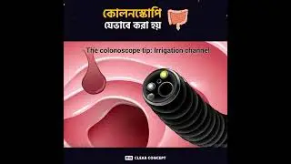 কোলনস্কোপি যেভাবে করা হয় - Colonoscopy