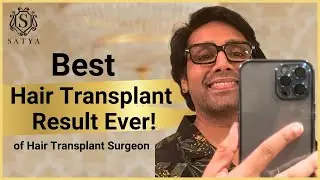 Hair Transplant Result Before After | Hair Transplant results | Result of FUE Hair Transplant | #fue