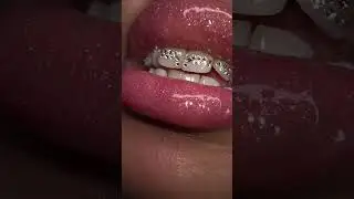 Gleam With Confidence: Sparkling Tooth Gems