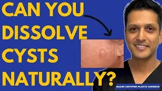 Can You Dissolve Cysts Naturally At Home?