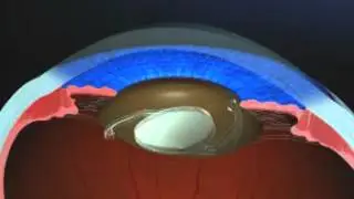 Lens Insertion Procedure at Lotus Eye Hospital, India