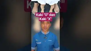 Kaki O dan X Bisa Diperbaiki? Ini Faktanya!#FisioCare #LatihanFisioterapi #KakiO #KakiX #edukasi