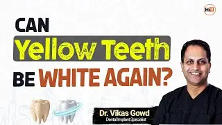 Can Yellow Teeth be White Again | Causes of Teeth Discoloration |Dr. Vikas Gowd| #dentist #hi9webtv