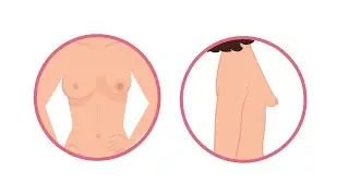இயற்கைக்கு மாறான மார்பகங்கள் | Tuberous Breast Correction | Chennai Plastic Surgery
