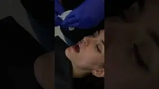 OptraGate Insertion: The Ultimate Lip Retraction Hack! #dental #dentistry #dentalcare