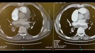 CT Angio Pulmonary Embolism WIth Contrast