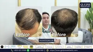 𝐇𝐚𝐢𝐫 𝐓𝐫𝐚𝐧𝐬𝐩𝐥𝐚𝐧𝐭 𝐌𝐚𝐥𝐚𝐲𝐬𝐢𝐚 | Gcell Stem Cell Therapy Client Testimonial After 5 Months