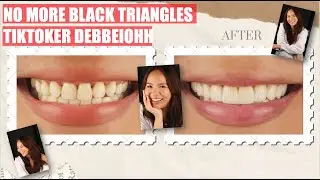 Tiktok Influencer Debbie got a smile upgrade & said goodbye to her black triangles | Apostol Dental