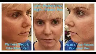 Jessicat's Plasma Fibroblast Healing Journey: Comparing Plamere vs. Plaxel+ Results