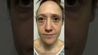 Пересадка жировой ткани в область нижнего века и подтяжка кожи для устранения впадин и мешков под...
