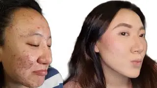 HOW TO COVER ACNE, HYPERPIGMENTATION, BLEMISHES, SCARS WITH LESS MAKEUP.