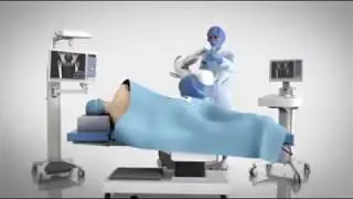 Stryker Mako robotic arm assisted total hip replacement