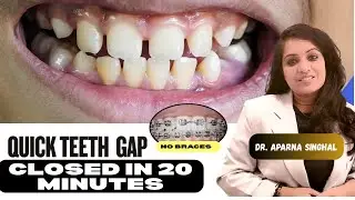 Teeth gaps closed in 20 minutes , Watch for full information 